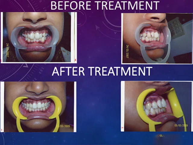 Discreet ceramic braces for precise teeth correction at Diksha Dental Clinic Coimbatore