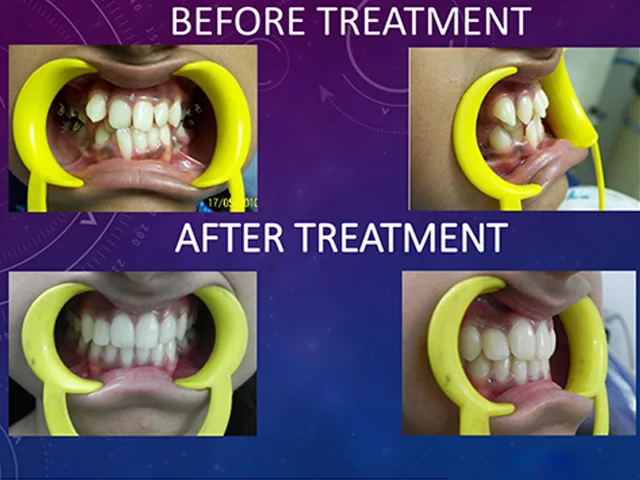 Comfortable clear aligner therapy for straighter teeth at Diksha Dental Coimbatore