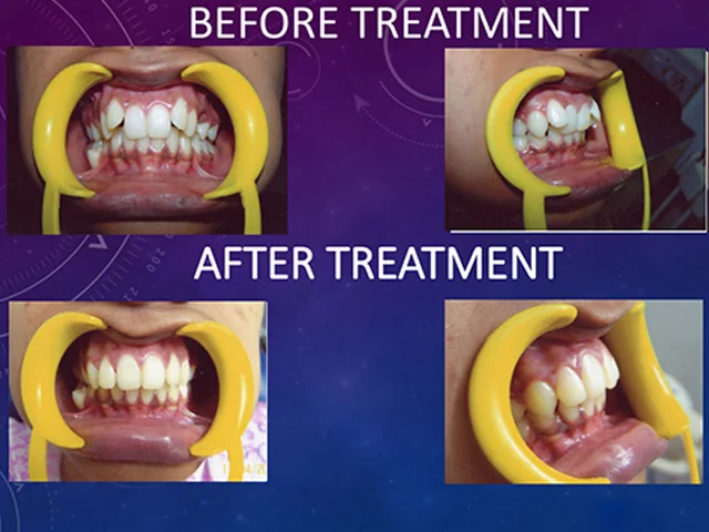 Expert dental braces treatment for proper teeth alignment at Diksha Dental Coimbatore