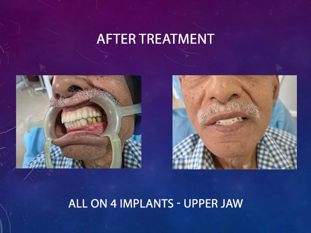 Precision dental implant surgery for permanent tooth replacement at Diksha Dental Coimbatore