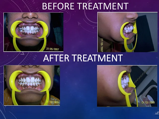 Comprehensive dental alignment treatment for all ages at Diksha Dental Coimbatore