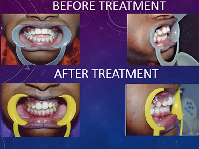 Clear invisible aligners for comfortable teeth alignment at Diksha Dental Coimbatore