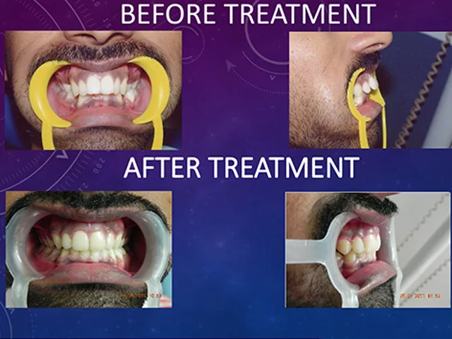 Clear invisible aligners for discreet teeth straightening at Diksha Dental Coimbatore