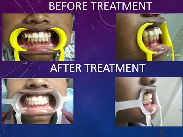 Reliable metal braces for correcting misaligned teeth at Diksha Dental Clinic Coimbatore