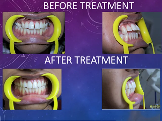 Professional orthodontic braces to correct bite and alignment at Diksha Dental Coimbatore