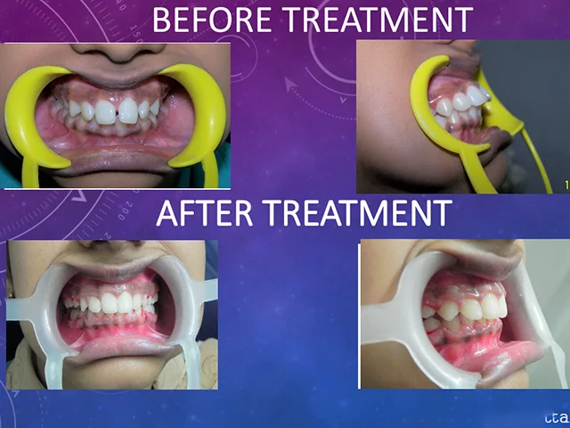 Correct crooked teeth with expert orthodontic alignment at Diksha Dental Coimbatore