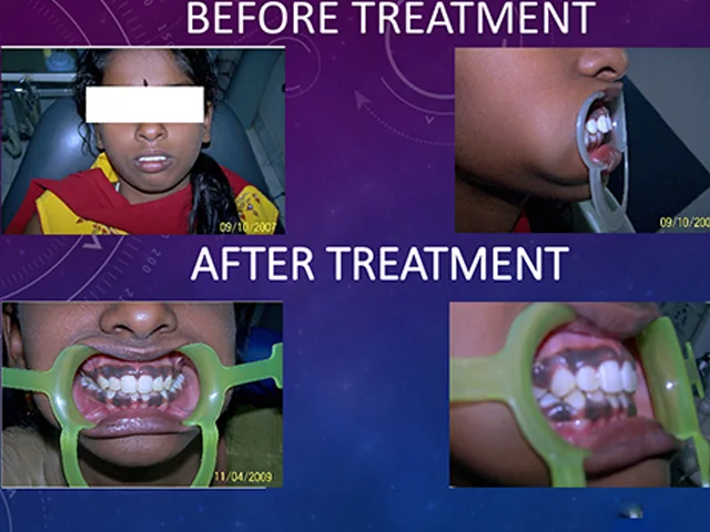 Visible orthodontic treatment results achieved at Diksha Dental Clinic Coimbatore