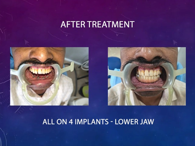 Expert orthodontist carefully aligning teeth for a perfect smile at Diksha Dental