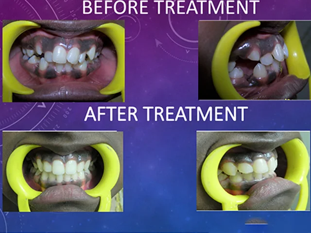 Improved smile alignment results after orthodontic treatment at Diksha Dental Coimbatore