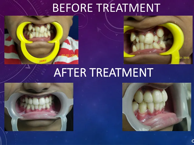 Achieve a perfect smile with professional teeth alignment at Diksha Dental Coimbatore