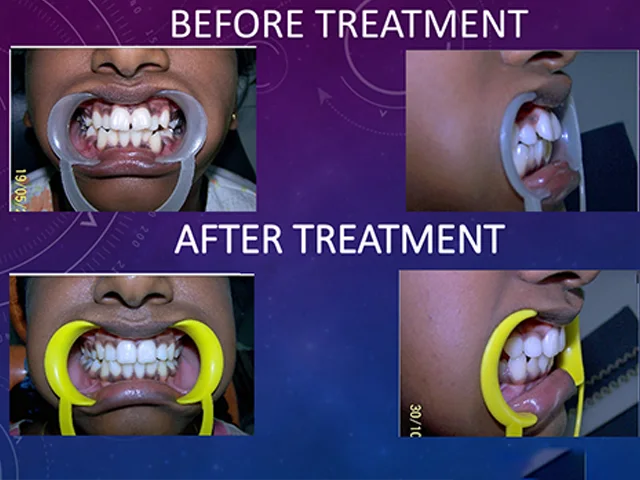 Effective traditional metal braces for complete teeth alignment at Diksha Dental Coimbatore